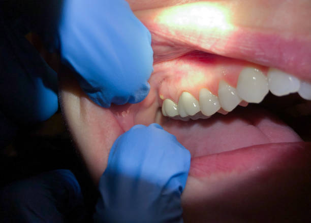 Tooth Infection Emergency Dentist in IA